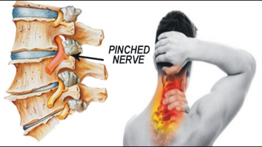 Pinched Nerve 
