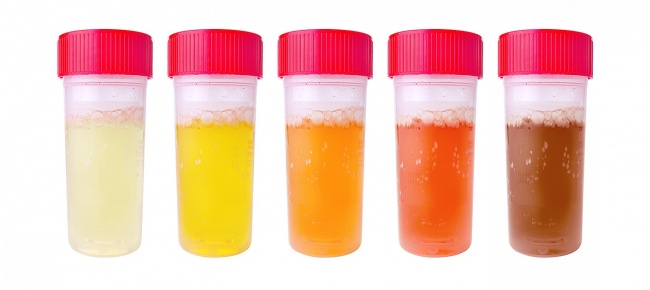 Perubahan warna pada urine dapat menjadi pertanda ginjal yang kurang sehat